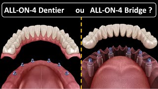 All on 4  Type de prothèse  Dentier ou Bridge [upl. by Imar527]