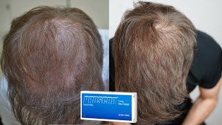 My Finasteride Results After 1 Year [upl. by Ayotna664]