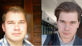 Truth About Finasteride My 12 Year Update Results [upl. by Artemahs]