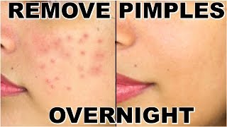 How To Remove Pimples Overnight  Acne Treatment  ShrutiArjunAnand [upl. by Anilrac]