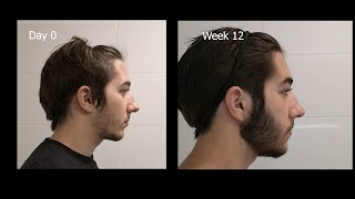 Minoxidil Beard Growth  3 Month Transformation  Timelapse BEFORE and AFTER [upl. by Kecaj]