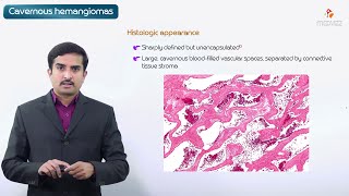 Cavernous hemangioma  Pathology Usmle step 1 [upl. by Eeltrebor]