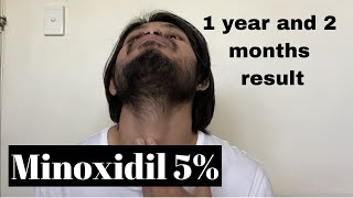 What to expect for applying once a day Minoxidil 5 [upl. by Sonitnatsnoc]