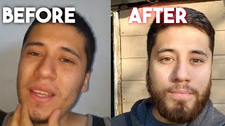 My Minoxidil Beard Journey Is Officially Complete  One Year After Stopping [upl. by Atilemrac]