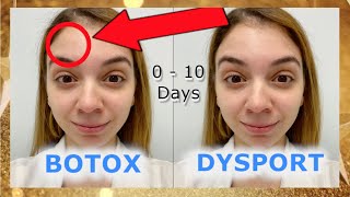 Botox Vs Dysport  Before and After [upl. by Aeniah]