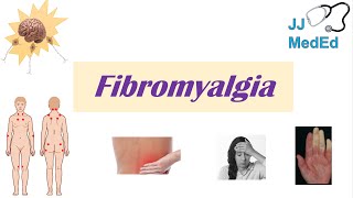 Fibromyalgia  Symptoms Associated Conditions Diagnosis Treatment [upl. by Dunn]