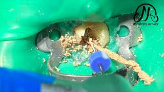 How To Remove GuttaPercha Easily During Root Canal Retreatment Cases  Easy GuttaPercha Removal [upl. by Lila617]