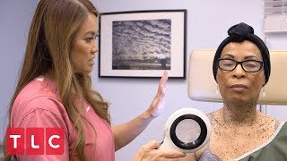 Removing Moles with Liquid Nitrogen  Dr Pimple Popper [upl. by Naerda]