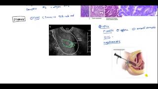 How is Endometrial Cancer Diagnosed [upl. by Kathlin485]