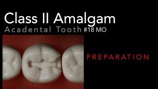 Class II Amalgam Preparation  18 MO Acadental Typodont [upl. by Hsaniva551]