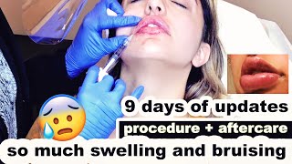 LIP FILLERS  First time tips for faster healing [upl. by Yrdua620]