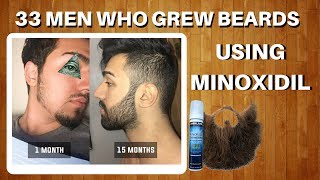 33 Men Who Grew Beards Using Minoxidil  The Minox Beard Spot  Minoxidil Beard Showcase [upl. by Tonya]