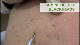 A Minefield of Blackheads  Dr Derm [upl. by Uile]