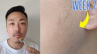 WEEK 7 MINOXIDIL BEARD GROWTH VELLUS HAIRS [upl. by Jaquelyn669]