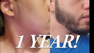 1 year of Minoxidil to grow a Beard BEARD TIMELINE [upl. by Atteloj]