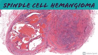 Spindle Cell Hemangioma 101 [upl. by Ennayoj393]