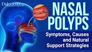 7 Natural Treatments amp Home Remedies For Nasal Polyps [upl. by Reba]