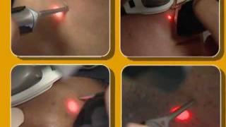 Laser Hair Removal video by Cynosure [upl. by Aihsenad]