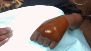 hand hematoma drainage [upl. by Zela]