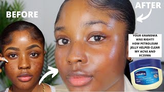 HOW VASELINE HELPED CLEAR MY ACNE AND EZCEMA FASTER  KAISERCOBY [upl. by Einneb]