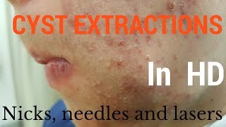 Cysts extractions blackheads  Removal methods in HD [upl. by Lozar454]