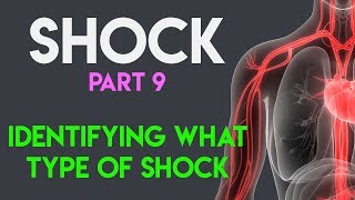 Identifying What Type Shock  Shock Part 9 [upl. by Sletten806]