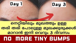 How To Remove Tiny Bumps From Face At Home How To Remove Pimples From Face In Just Three DaysMalus [upl. by Yzdnil]