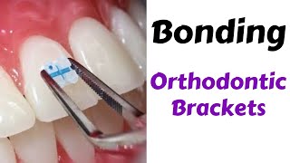 Step by Step Orthodontic Brackets Bonding Technique MBT  orthodontic lecture [upl. by Isolde]