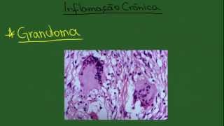 Inflamação Crônica  Resumo  Patologia Geral [upl. by Tully]