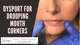 Dysport Injections to DAO Muscle for Drooping Mouth Corners [upl. by Nosro]