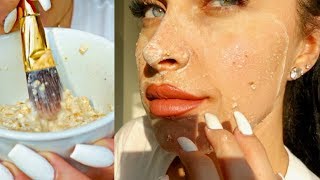 DIY CLEAR SKIN FACE MASK  How To Get Rid of Pimples  Acne Overnight At Home 100 Natural [upl. by Naryt]