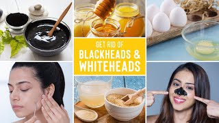 Easy Ways To Remove Blackheads And Whiteheads At Home [upl. by Akirre]