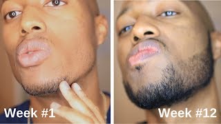 Minoxidil Beard Journey 3 Month Transformation [upl. by Ardekan189]