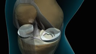 Torn Knee Meniscus Repair [upl. by Edra316]