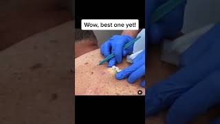 Blackheads Popping amp Blackhead Removal Videos 2022 [upl. by Aztinaj]