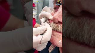 Pebble like Cyst Drained by Dr HL Greenberg at Las Vegas Dermatology® [upl. by Ahseyn]